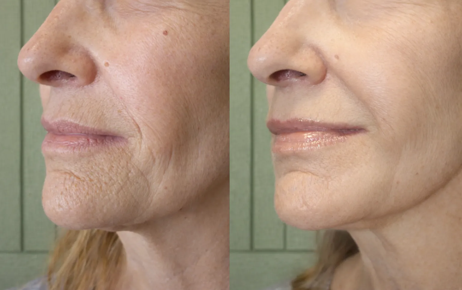 Für wen ist RF-Microneedling geeignet?